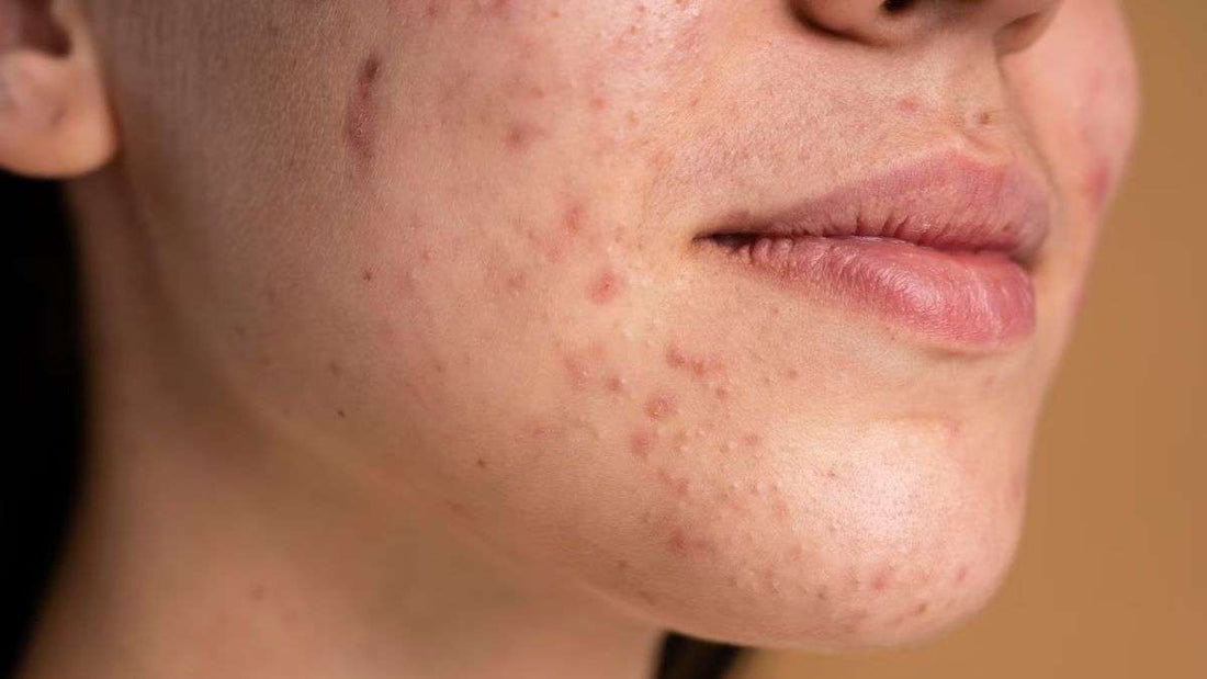 Lets Talk Inflammatory Skin Concerns